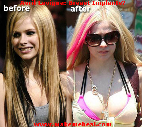 avril-lavigne-breast-implants.jpg